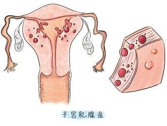 子宫腺肌症会影响排卵吗