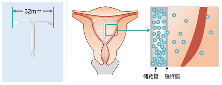 子宫腺肌症带曼月乐还疼是怎么回事