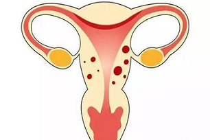 子宫异常出血，是女性健康的报警信号
