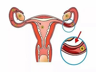输卵管堵塞就是输卵管粘连吗