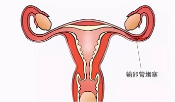 输卵管堵塞为什么没有症状