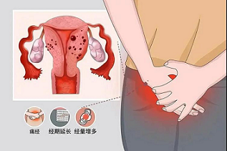 子宫腺肌症有哪些症状和危害