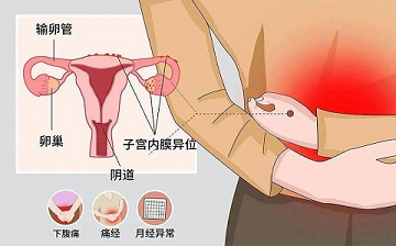 子宫内膜异位症止疼方法