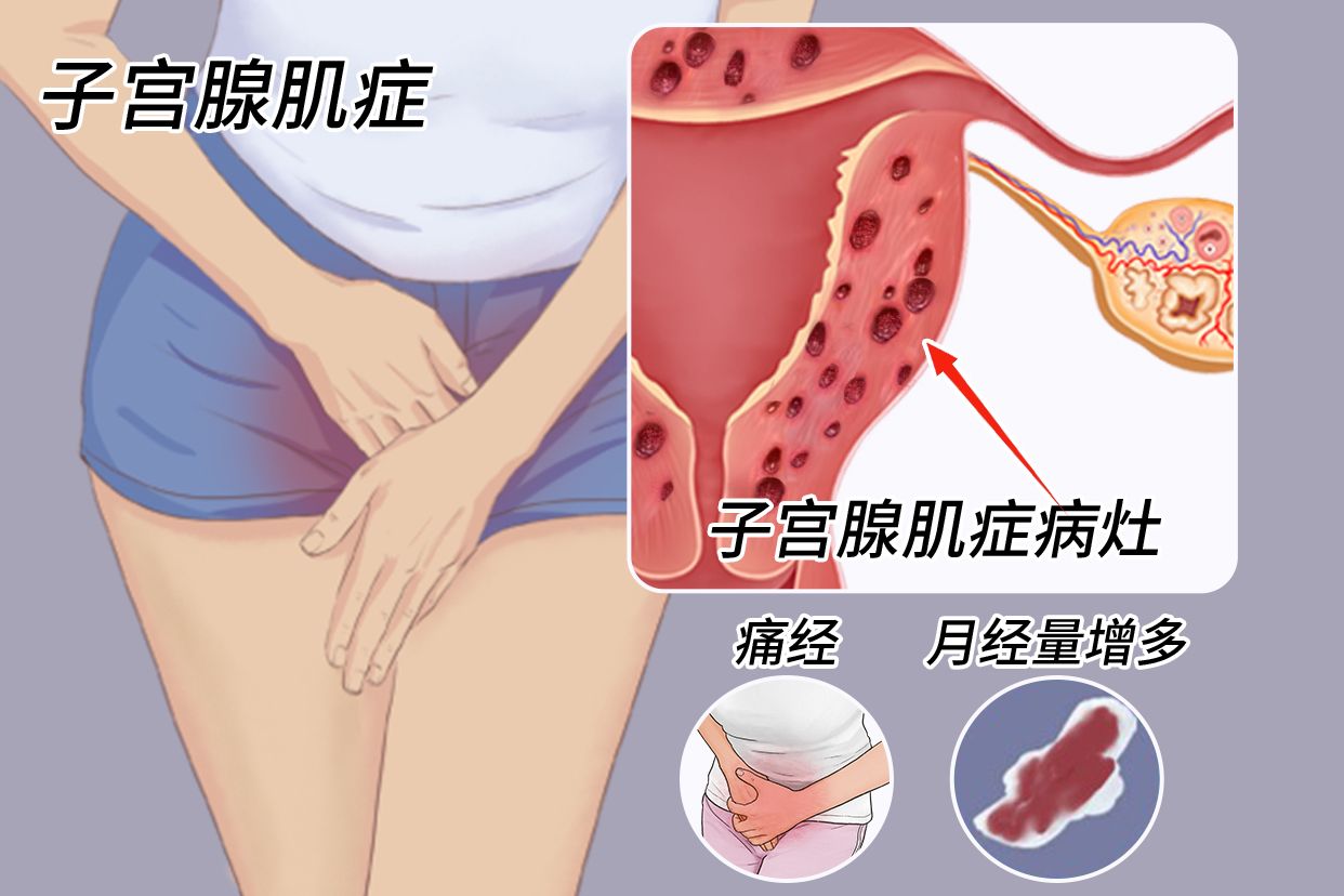 子宫腺肌症伴盆腔充血疼痛中药治疗方法