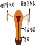 妇炎丸治疗输卵管堵塞、积水、粘连超过手术