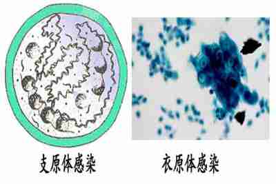 支原体衣原体感染