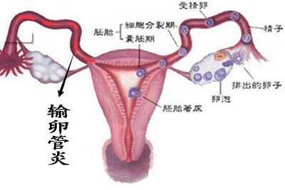 输卵管炎