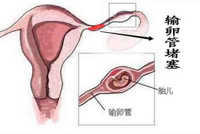 输卵管堵塞