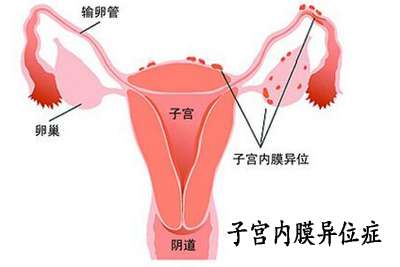 子宫内膜异位症