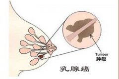 少年左胸长硬块疙瘩 病理检查是乳腺癌