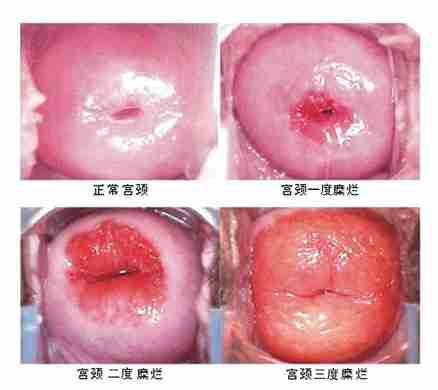 宫颈糜烂