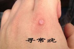 男童鼻子上现小丘疹 原是寻常疣