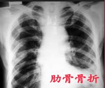 拥抱不当造成骨折 9旬老太肋骨骨折