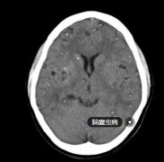 以为得了癫痫做CT 原来是脑囊虫病