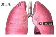 K歌太嗨 吼破了肺吼出肺大泡