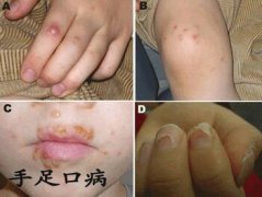  今年或为手足口病高发期 牢记15字成功预防