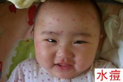 春季水痘爱“缠人” 成人患上更凶险