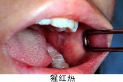 孩子易遭猩红热侵袭 最好隔离治疗