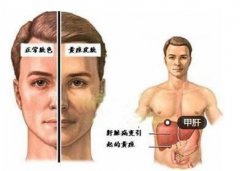 预防春季甲肝 应把好“病从口入”关