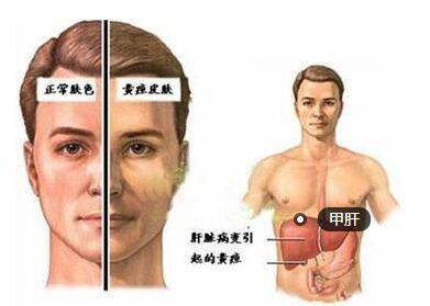 甲肝