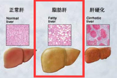 “以毒攻毒” 利用饮食把脂肪肝“吃”回去