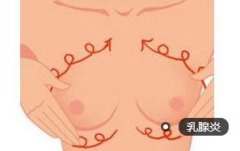 乳腺炎最喜侵袭新妈妈 患病后是否还可继承哺乳