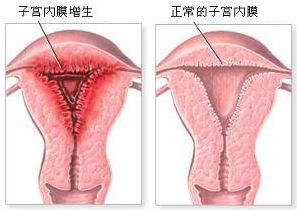 子宫内膜增生