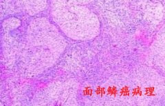 脸上长黑斑且面积不断变大 警惕面部鳞癌