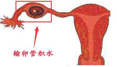 输卵管积水