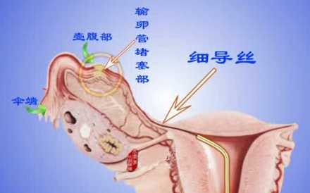 双侧输卵管都堵塞