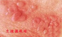 不洁性交当心生殖器疱疹 有效护理保健康