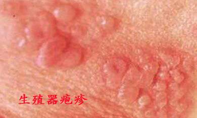 生殖器疱疹