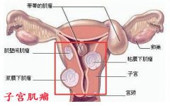 腹部肿大无妊娠反应  警惕子宫肌瘤
