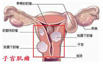 子宫肌瘤