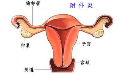 附件炎