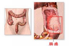 持续大便带血需警惕 或有肠癌可能