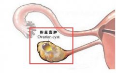 女性“腰围突增” 当心卵巢囊肿