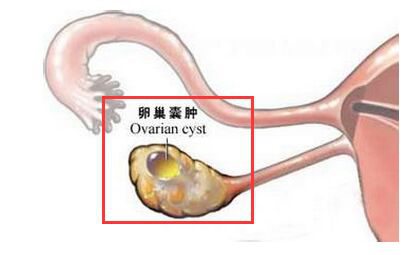 卵巢囊肿