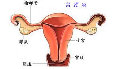 宫颈糜烂