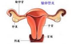 淋菌性输卵管炎 不能忽视性伴侣的治疗