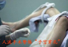人流易致子宫穿孔 紧急救治保健康