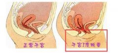 腹部下坠当心子宫脱垂 六旬以上女性更需留心