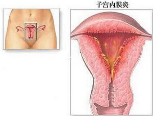 子宫内膜炎增厚