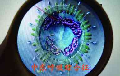 中东呼吸综合征