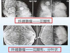 “爱美出错”当心乳腺纤维瘤 术后调理很重要