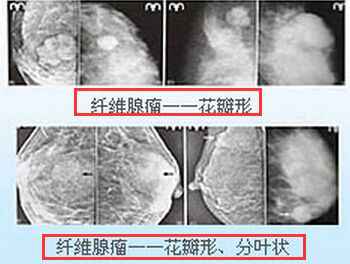 乳腺纤维瘤