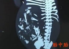孕妇产下罕见胎中胎 百万分之一概率也中招