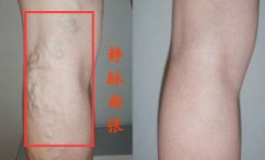 腿痒一年多 或有静脉曲张可能