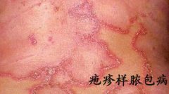 孕后出现红疙瘩和脓疱 小心疱疹样脓疱病