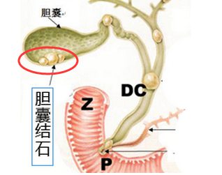 胆囊结石